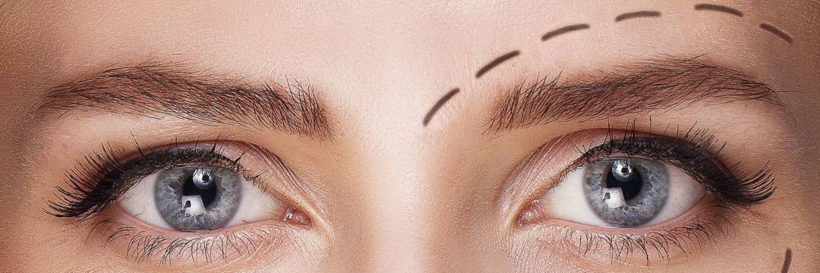 blefaroplastia